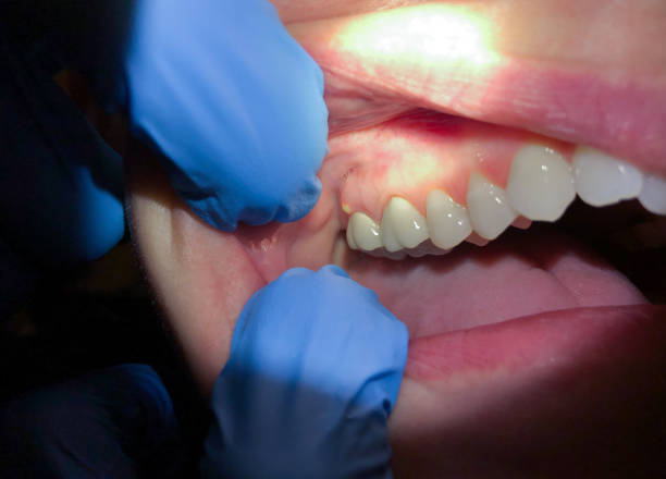 Best Emergency Dental Care for Abscessed Tooth in Granite Quarry, NC